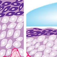 vaginal-dryness